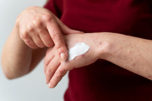 Closeup of a hand applying cream to skin irritation on the back of the other hand.